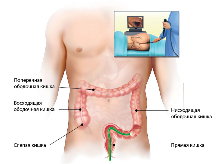 Колоноскопия